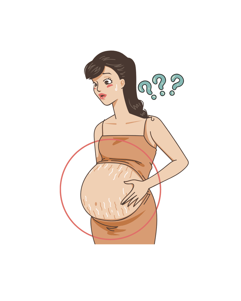 Stretch Marks in Pregnancy — Can You Really Prevent Them, or Is It Just a Myth?